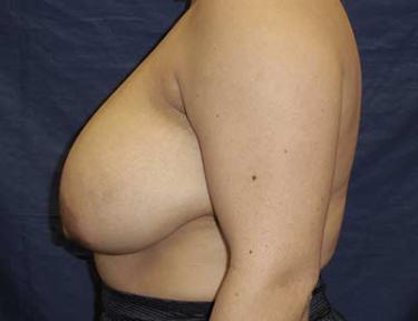 Before Results for Breast Reduction