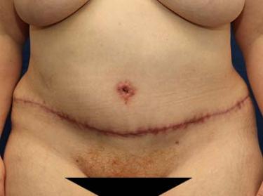 After Results for Tummy Tuck