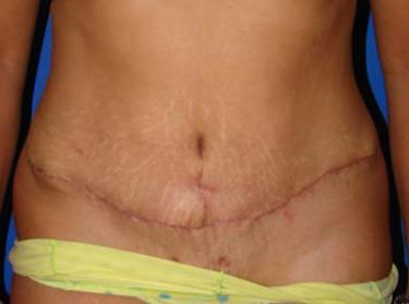 After Results for Tummy Tuck