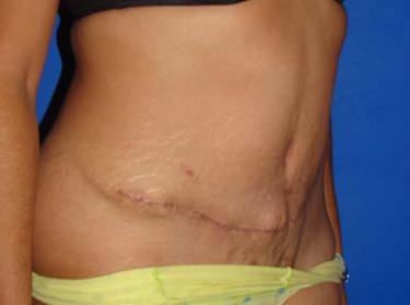 After Results for Tummy Tuck