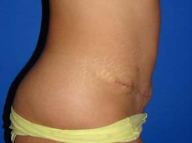 After Results for Tummy Tuck