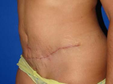 After Results for Tummy Tuck