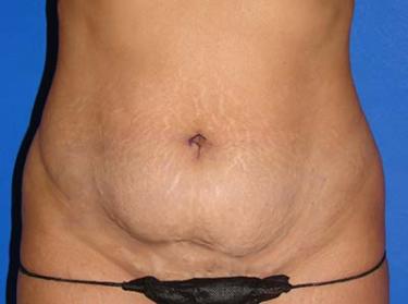 Before Results for Tummy Tuck