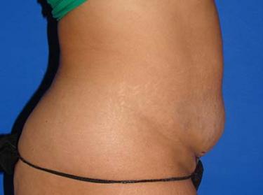 Before Results for Tummy Tuck