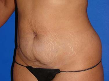 Before Results for Tummy Tuck