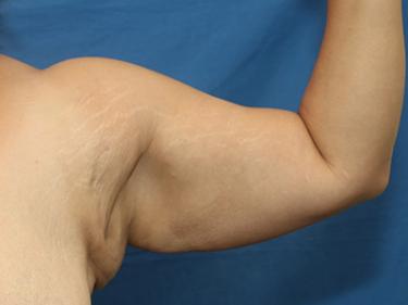 Before Results for Brachioplasty / Arm Lift