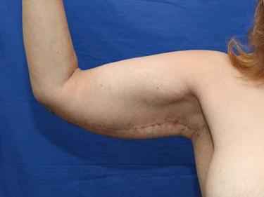 After Results for Brachioplasty / Arm Lift