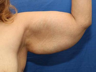 Before Results for Brachioplasty / Arm Lift