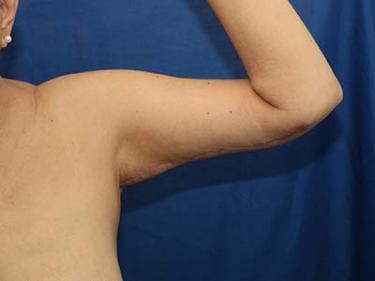 After Results for Brachioplasty / Arm Lift