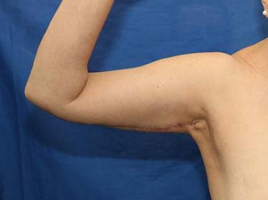 After Results for Brachioplasty / Arm Lift