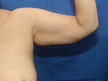 Before Results for Brachioplasty / Arm Lift