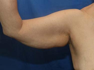 Before Results for Brachioplasty / Arm Lift