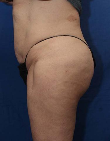 After Results for Liposuction, Brazilian Butt Lift / Gluteal Augmentation