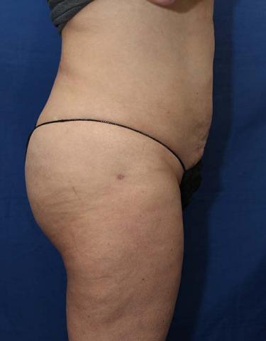 After Results for Gluteal Augmentation