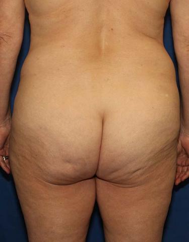 Before Results for Gluteal Augmentation