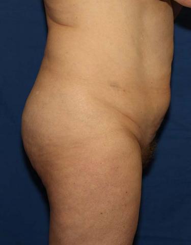Before Results for Liposuction