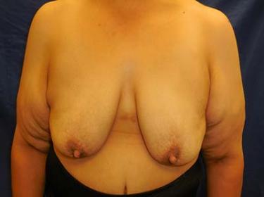 Before Results for Breast Lift