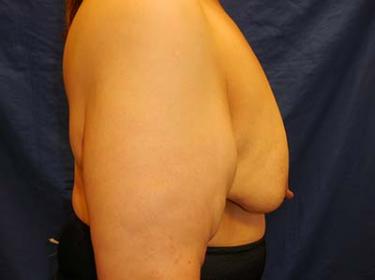 Before Results for Breast Lift / Mastopexy