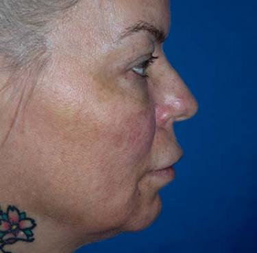 After Results for Tissue Fillers