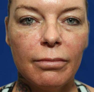 Before Results for Tissue Fillers