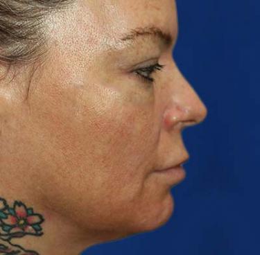 Before Results for Tissue Fillers