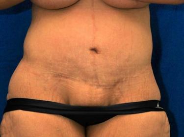 After Results for Tummy Tuck