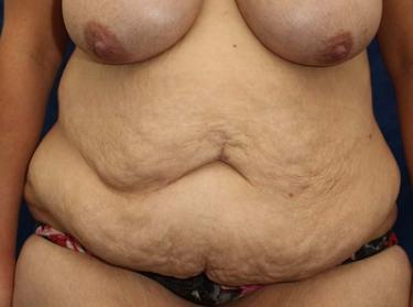 Before Results for Tummy Tuck