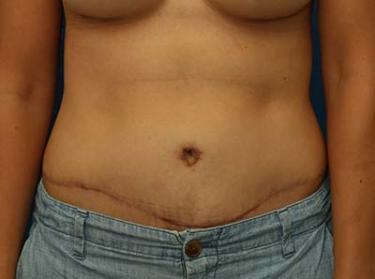 After Results for Tummy Tuck