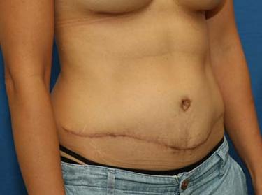 After Results for Tummy Tuck