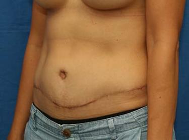 After Results for Tummy Tuck