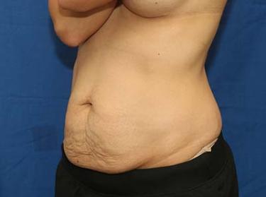 Before Results for Tummy Tuck