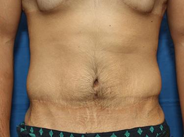 After Results for Tummy Tuck