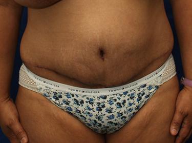 After Results for Tummy Tuck