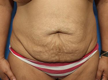 Before Results for Tummy Tuck