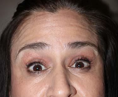 After Results for Botox