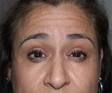 Before Results for Botox