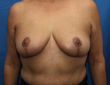 After Results for Breast Reduction