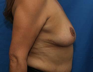 After Results for Breast Reduction