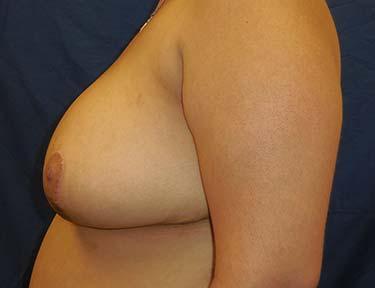 After Results for Breast Reduction