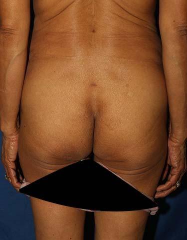 After Results for Brazilian Butt Lift / Gluteal Augmentation