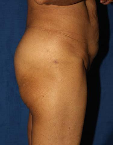 After Results for Brazilian Butt Lift / Gluteal Augmentation