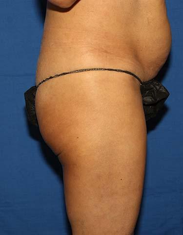 Before Results for Gluteal Augmentation