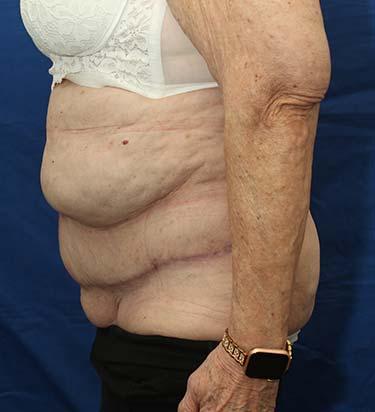 After Results for Panniculectomy
