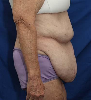 Before Results for Panniculectomy