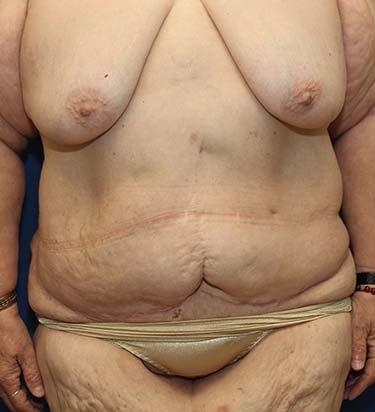 After Results for Panniculectomy