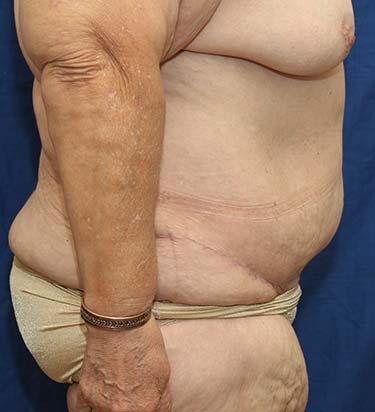 After Results for Panniculectomy