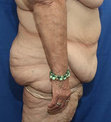 Before Results for Panniculectomy