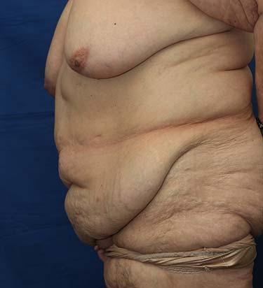 Before Results for Panniculectomy