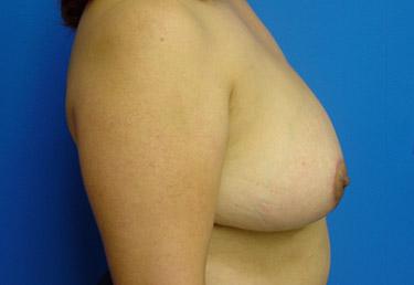 After Results for Breast Reduction