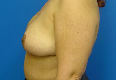 After Results for Breast Reduction